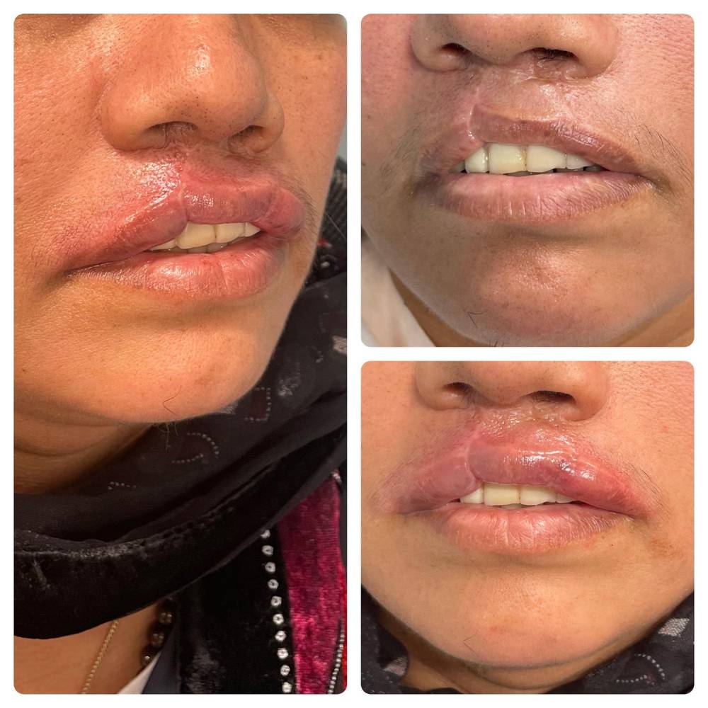 treatment-healing-for-lips-3-photographs